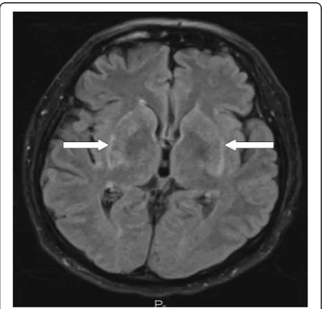 Fig. 3 Susceptibility-weighted imaging magnetic resonance imagingof the brain showing (see arrows) an areaof inflammatory increasedsignal within the basal ganglia (August 2016)