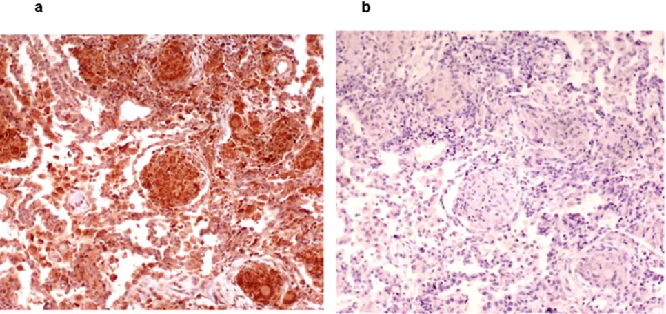 Figure 3αnecrosis factor-immunostaining (brown), 200× magnification. Immunohistochemical staining for tumor necrosis factor- in lung tissue biopsyImmunohistochemical staining for tumor necrosis factor-α in lung tissue biopsy