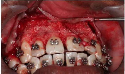 Figure 8. Vertical and horizontal cuts on the cortical bone along with surface decortication bur holes on the palatal aspect of the maxillary arch 