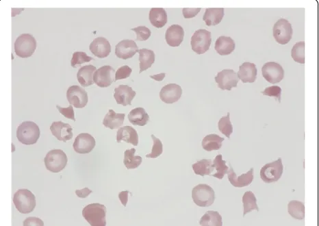 Fig. 3 Peripheral blood smear shows multiple fragmented red cells.The platelet count is reduced