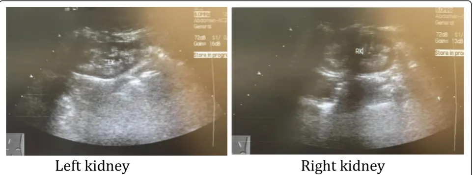 Fig. 1 Renal ultrasonographic images show increased reflectivity of the renal pyramids, which demonstrate nephrocalcinosis