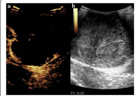 Fig. 1 a Contrast-enhanced Ultrasonographic images showing thatthe mass enhanced from the periphery at 25 seconds after the bolusinjection of SonoVue contrast agent