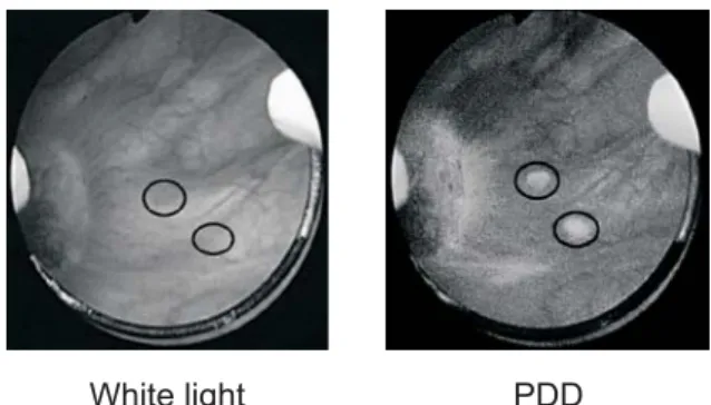 Fig. 1: Papillary tumors in different illuminations