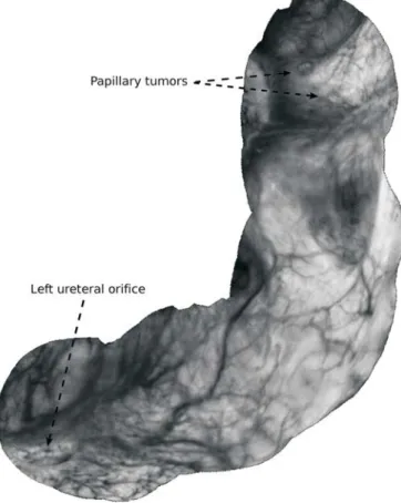 Fig. 11: Panoramic image built from an original endoscopic PDD video sequence of 580 frames