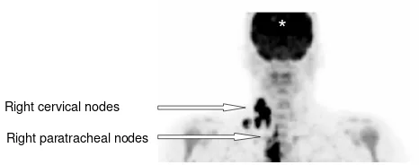 Figure 2chest, abdomen and pelvisCoronal PET image of FDG uptake and excretion in the Coronal PET image of FDG uptake and excretion in the chest, abdomen and pelvis.