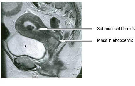 Figure 3pelvisSagittal T2-weighted MR image through the midline of the Sagittal T2-weighted MR image through the midline of the pelvis.