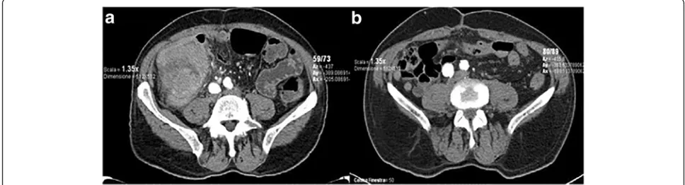 Fig. 1 Computed tomography scan describing a mass involving cecum and ascending colon (a) and the absence of recurrence at a 4-yearfollow-up (b)