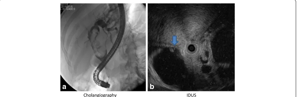 Fig. 1 a Cholangiogram shows a large oval-shaped filling defect (arrow) in the common hepatic duct with intrahepatic duct dilation