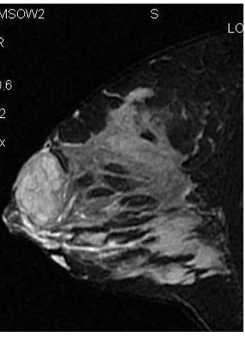 Figure 3Appearance of breast six months after surgeryAppearance of breast six months after surgery.