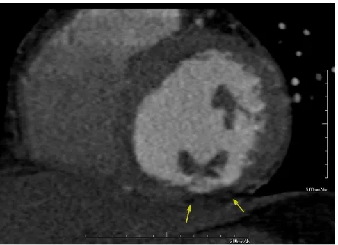 Figure 1circulationright (1b) coronary circulationCoronary computed tomography angiography shows absence of flow limiting stenosis in both left (1a) and right (1b) coronary Coronary computed tomography angiography shows absence of flow limiting stenosis in