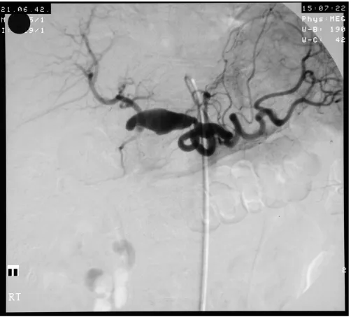 Figure 1Angiogram showing the patient's large hepatic artery aneurysmAngiogram showing the patient's large hepatic artery aneurysm.