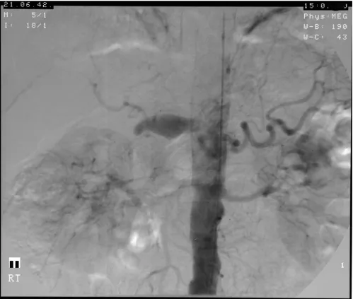 Figure 2Angiogram showing the patient's large hepatic artery aneurysmAngiogram showing the patient's large hepatic artery aneurysm.