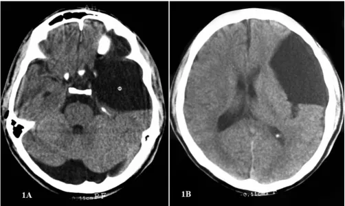 Figure 1the middle cranial fossaComputed tomographic scan of the head without contrast immediately following the trauma, showing a giant arachnoid cyst in Computed tomographic scan of the head without contrast immediately following the trauma, showing a giant arachnoid cyst in the middle cranial fossa.