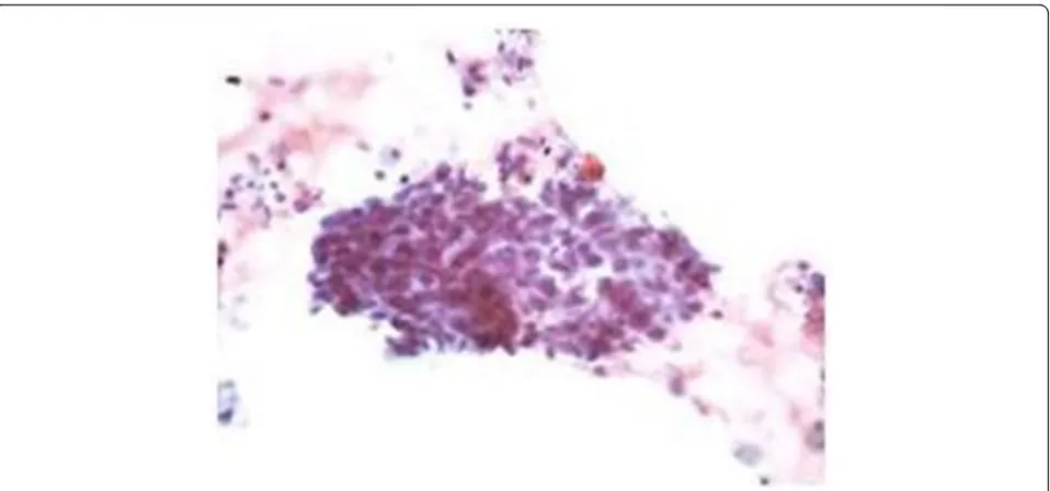 Fig. 2 acells with basal nuclei (hematoxylin and eosin stain, high magnification). Adenocarcinoma with acinar pattern shows glands with greater architectural complexity and a back-to-back arrangement (hematoxylinand eosin stain, low magnification)