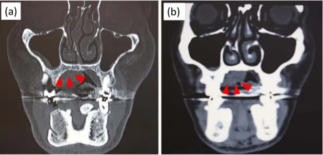 Figure 3. CT findings. (a) Hard tissue mode; (b) Soft tissue mode. No bone destruction is observed in the right mandibular bone of the tumor-equivalent part