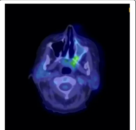 Fig. 1 Computed tomography scan revealing a large soft tissue mass opacifying the left maxillary, ethmoidal, frontal, and sphenoid sinuses