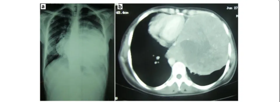 Fig. 1 A chest X-ray shows a homogenous left-sided opacity occupying almost the entire left hemithorax, with non-visible left diaphragmatic dome(a)