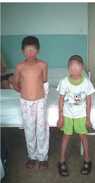 Figure 3matched boy (left)The patient with Kearns-Sayre syndrome (right) with an age-The patient with Kearns-Sayre syndrome (right) with an age-matched boy (left).