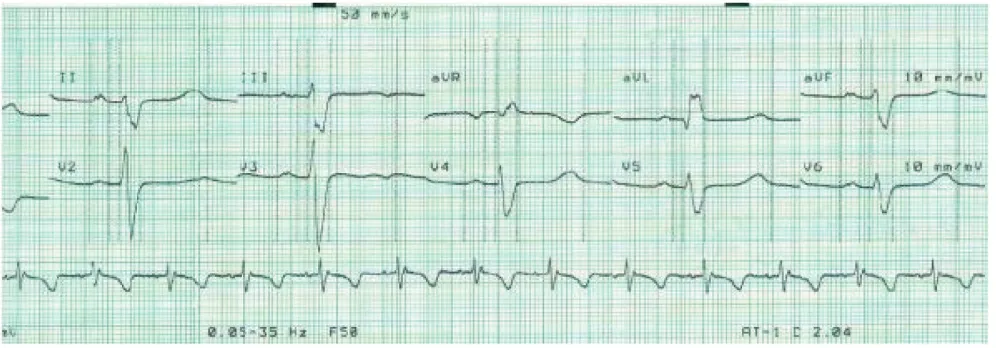 Figure 4Electrocardiogram - cardiac conduction defectElectrocardiogram - cardiac conduction defect.