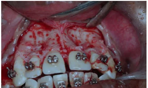 Figure 6. Corticotomy cuts 