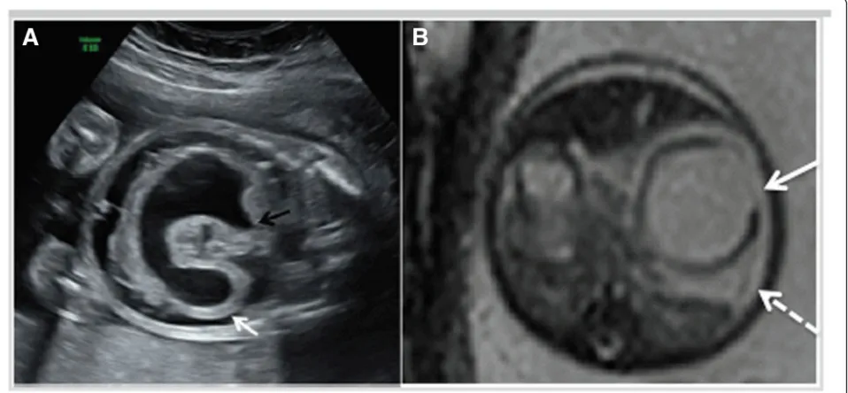 Fig. 1 aof the twin pregnancy showing the dilated fluid-filled stomach with evidence of wall rupture (duodenum ( Transverse ultrasound image of twin B showing the dilated and thick-walled stomach with a “cut-off” at the second portion of thewhite arrow)