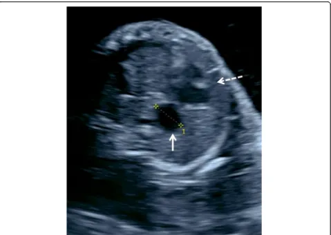Fig. 2 Transverse ultrasound view of the fetal chest showing the cystic structure (white arrow) posterior to the heart (dashed arrow)