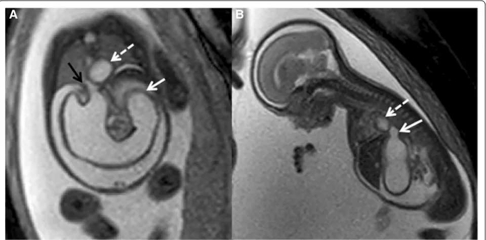 Fig. 3 a Coronal T2-weighted magnetic resonance image shows a dilated stomach with cut-off at the second–third duodenal segment (solidwhite arrow), fluid-filled hiatal hernia (black arrow), and the dilated distal esophagus (dashed arrow) correlating with t