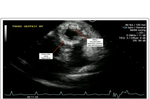 Fig. 2 Transesophageal echocardiography showing multiple independent echodensities on the leaflets with significant soft tissue infiltration ofthe valve itself