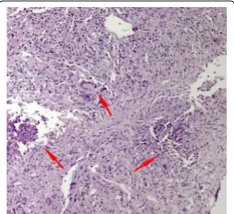 Figure 1 Lung biopsy (fine needle biopsy), periodic acid Schiffstain ×400 magnification.