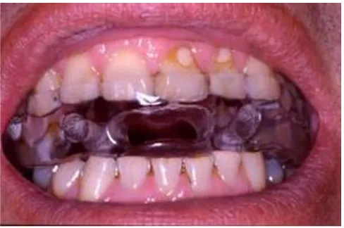 Figure 1An example of a mandibular advancement device.