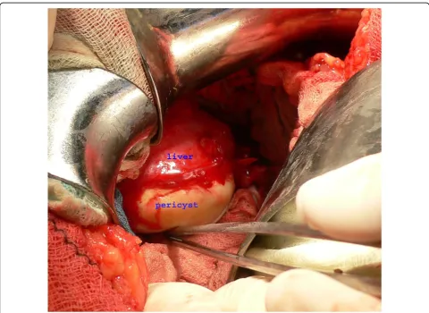 Figure 1 Intraoperative view: Outer side of calcified hydatid cyst tightly attached to the liver.