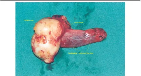 Figure 2 The outer side of the removed cyst together with the gallbladder and a small part of the liver.