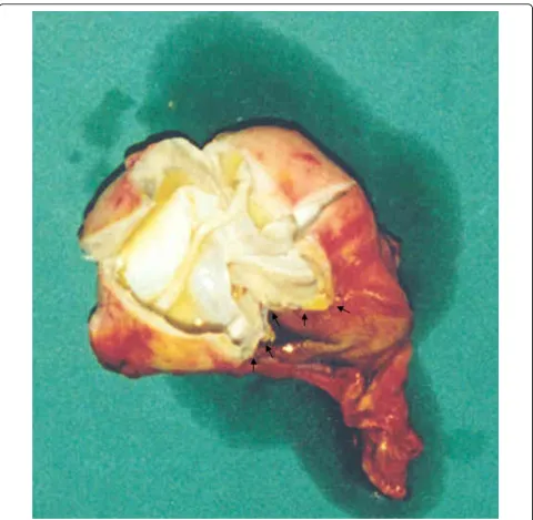 Figure 3 The inner side of the cyst developed entirely extramucosally
