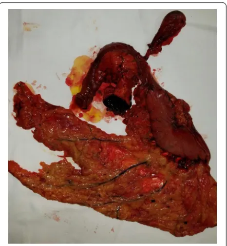 Fig. 4 Surgical specimen after duodenopancreatectomy