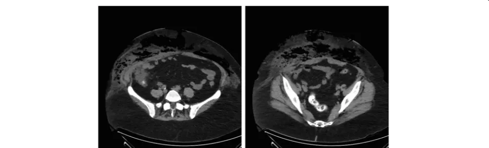 Fig. 1 Computed tomography performed on the patient’s admission shows extensive emphysema in the subcutaneous tissue without any signsof an intraabdominal infection