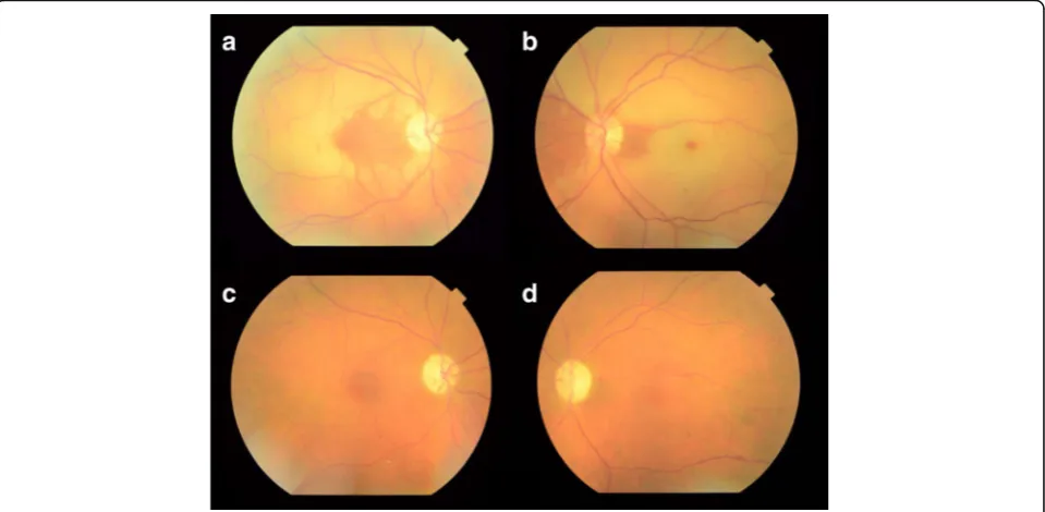 Fig. 1 Fundus color photographs of both eyes. a One week after foveal-sparing central retinal artery occlusion in the right eye, diffuse macular edemais present except for nasal parafovea and perifovea
