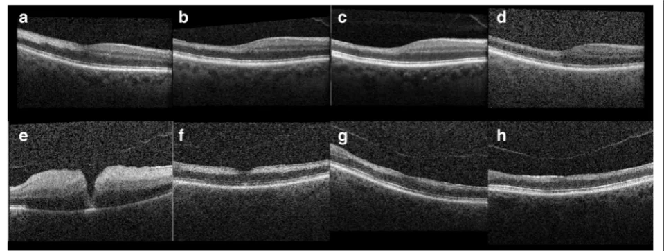 Fig. 2 Spectral domain optical coherence tomography of both eyes. a–d Spectral domain optical coherence tomography of the right eyeobtained at 1, 3, 5, and 7 months respectively after the central retinal artery occlusion