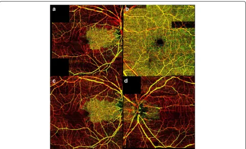Fig. 3 Optical coherence tomography-based microangiography images of both eyes.occlusion in the left eye.artery occlusion in the left eye, diffuse loss of microvasculature is shown