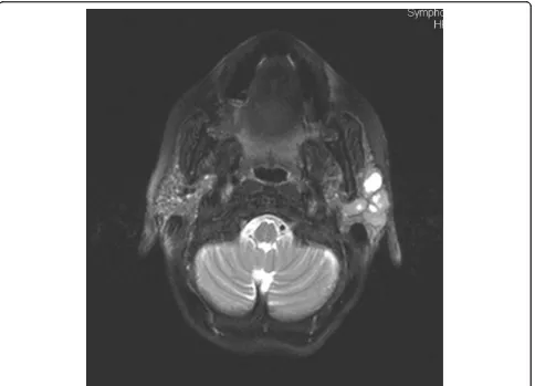 Figure 1 Axial T2-weighted image reveals an enlargement of the left parotid gland and a total replacement of the normalparenchyma with mixed-type solid and cystic lesions.