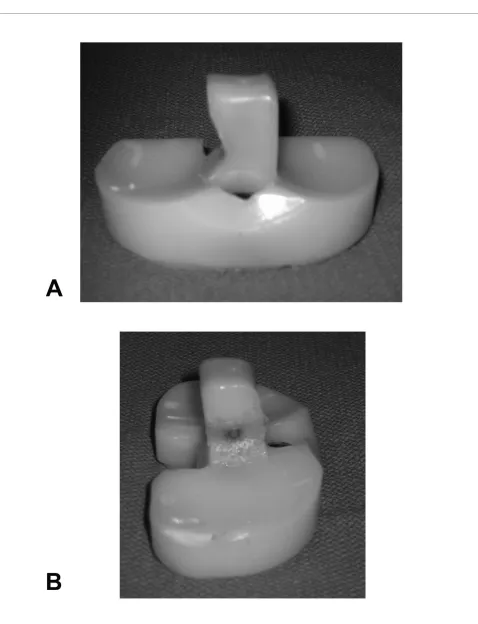 Figure 2 Photograph showing significant wear along the medial side of the post of polyethylene insertylene exposing central metal post 