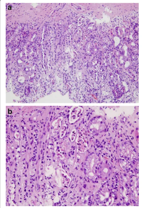 Fig. 1 aglands with eosinophilic granular debris and apoptotic nuclear Full thickness of gastric antrum showing denuded epithelium,loss of glands, dilated glands, and relatively few inflammatory cells inthe lamina propria