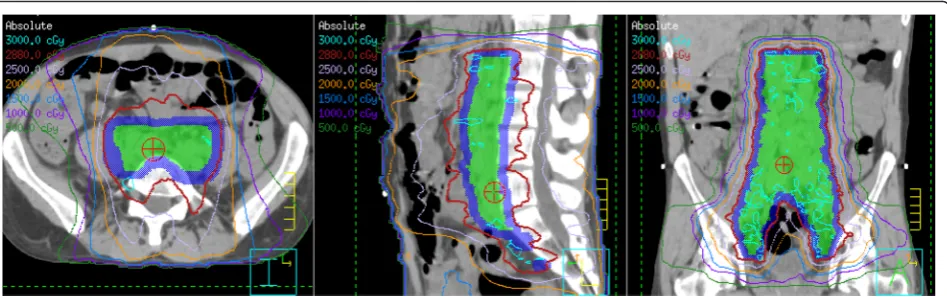 Fig. 2 Intensity-modulated radiation therapy plan for Case 1 shows the 28.8 Gy that had been delivered when graft-versus-host symptomsappeared