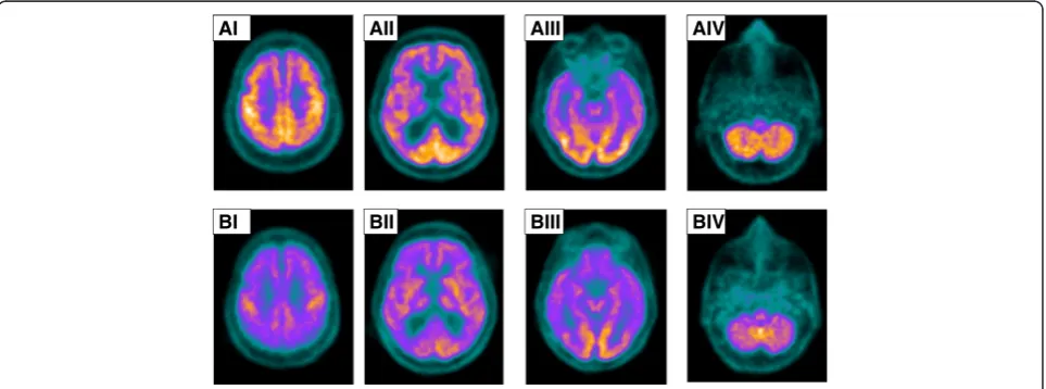 Fig. 2 Cerebral scans (axial slices, I–IV) obtained by 2-deoxy-2-[fluorine-18]fluoro-D-glucose integrated with computed tomography-positron emissiontomography