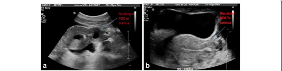 Fig. 1 Laparoscopic intraoperative images of Case 1. a The left cornu of the uterus is thin and tensely distended with a gestational sac
