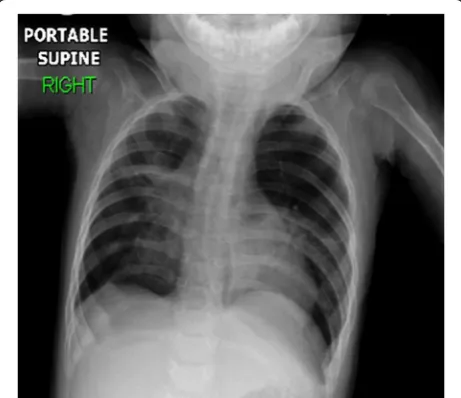 Fig. 2 Computed tomography angiography axial view belowbifurcation of carina shows basal lung atelectasis, lung hyperinflation,and enlarged main pulmonary artery