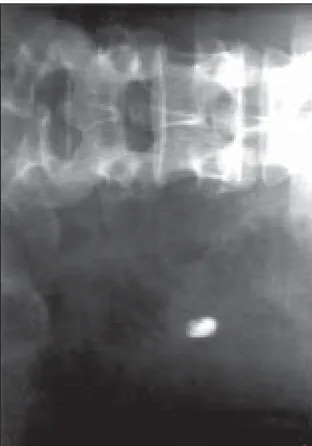 Fig. 7: Image of compression coated sennosides tablet in ascending colon after 4 h.
