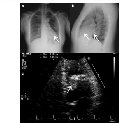 Fig. 1 Chest x-ray and echocardiogram of the patient. a and b Chest x-rays show a needle in the heart and lung, respectively (white arrows)