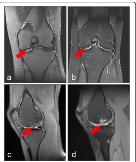 Fig. 1 Preoperative and postoperative magnetic resonance imagingof the patient’s left knee