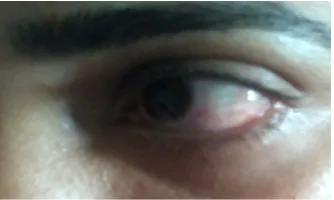 Figure 3: Patient’s left eye on the last day of treatment 