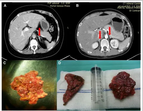 Fig. 1 Computed tomography of the adrenal glands and gross pathology of the lesions. Patient 1: Computed tomographic scan of her adrenalpale brown nodules (shows cut surface of left adrenal gland with multiple brown nodules (micronodular appearance of both